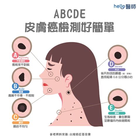 身體上的痣|皮膚長痣、長斑是皮膚癌前兆？皮膚癌初期4大症狀快。